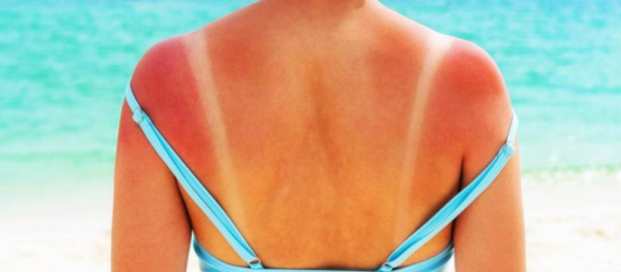 Comment réparer sa peau après un coup de soleil ?