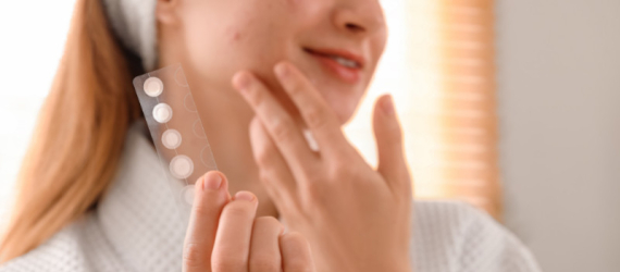 Acné après l’été : pourquoi les boutons reviennent-ils à la rentrée ?